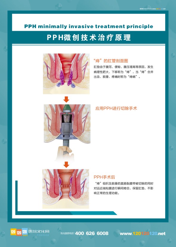 肛腸科解剖圖-PHH微創(chuàng)技術(shù)治療原理